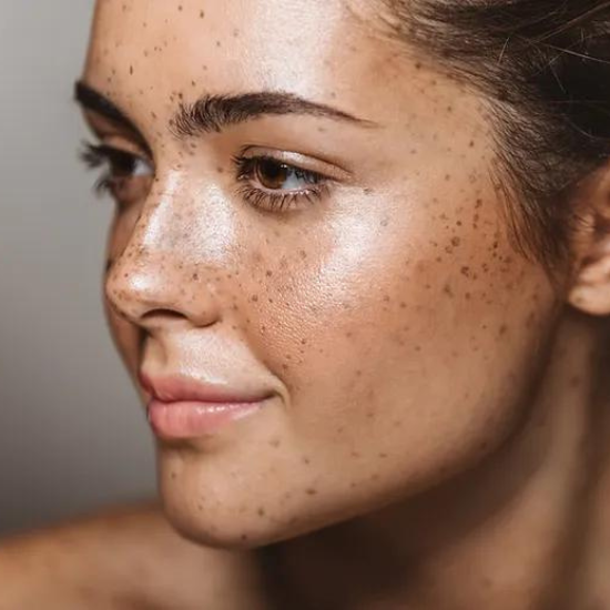 Pigmentation is the discoloration of the skin, often seen as spots or patches from excess melanin production caused mainly by UV exposure. Hormonal changes, birth control pills, and acne can also contribute.